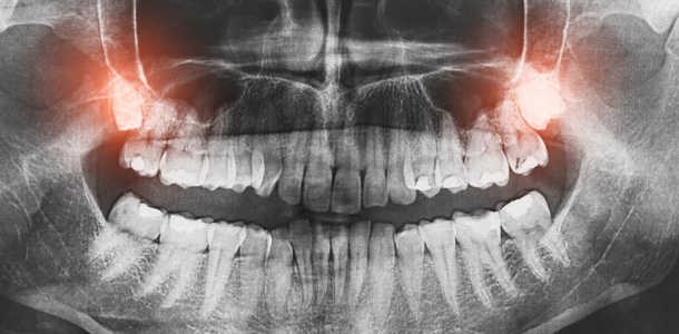 X ray of teeth with the wisdom teeth highlighted red