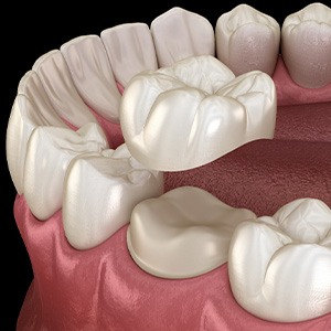 Illustration of crown being attached to tooth in lower arch
