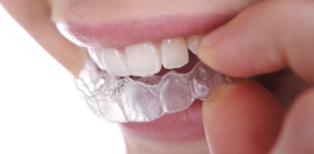 Close up of a person placing a clear aligner over their teeth