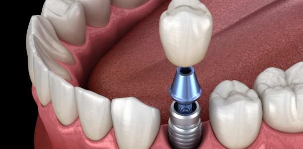 Illustrated dental crown being placed onto a dental implant in Heber City