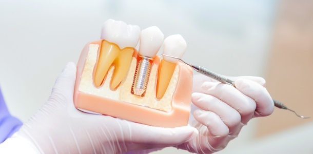 Dentist pointing to a model of a dental implant