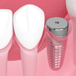 Digital illustration of a dental implant