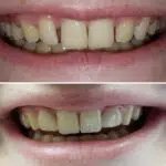 Close up of smile before and after dental treatment