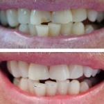 Smile before and after receiving dental treatment