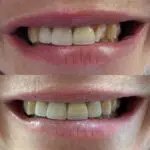 Smile before and after dental work
