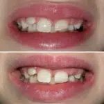Smile before and after receiving dental treatment