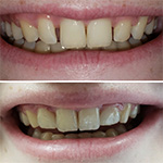 Smile before and after receiving dental treatment