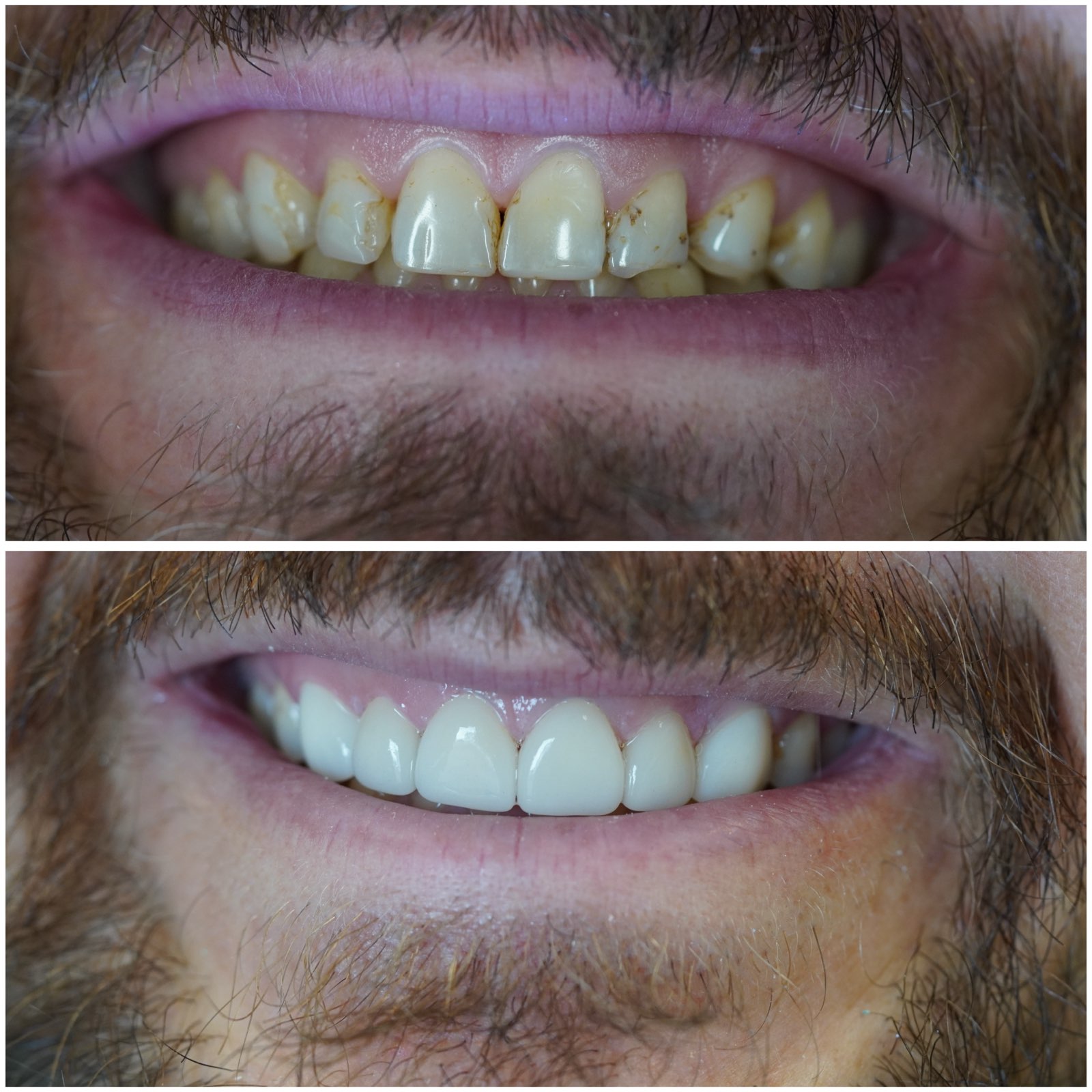 Smile before and after receiving dental treatment