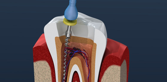 The root canal process includes removing the infected tooth pulp to stop the pain and prevent the infection from spreading.