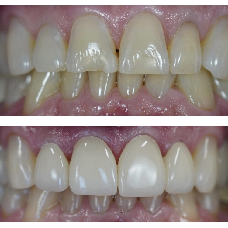 Smile before and after dental work