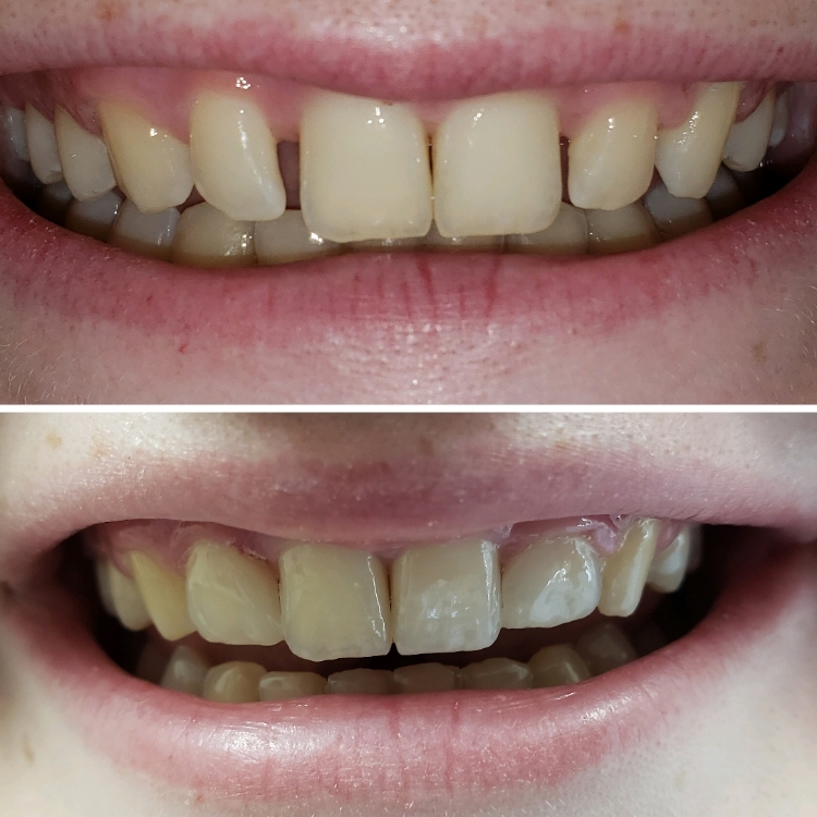 Smile before and after dental work