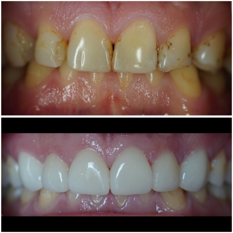 Smile before and after receiving dental treatment