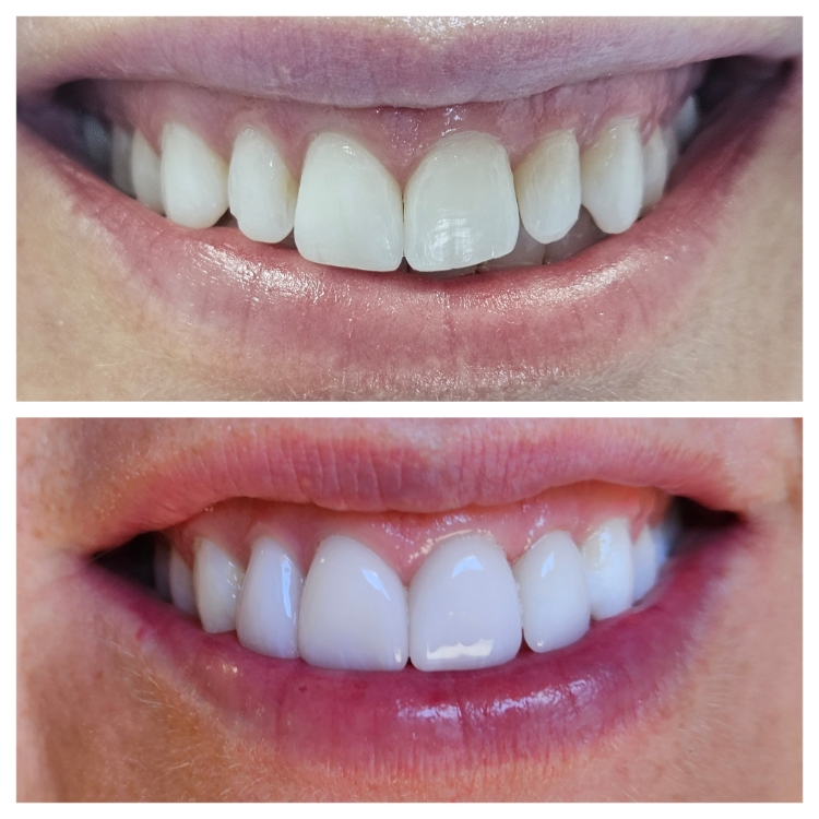Smile before and after receiving dental treatment