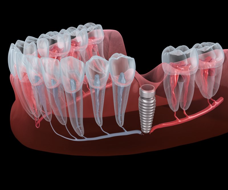 Illustration of implant in gum tissue