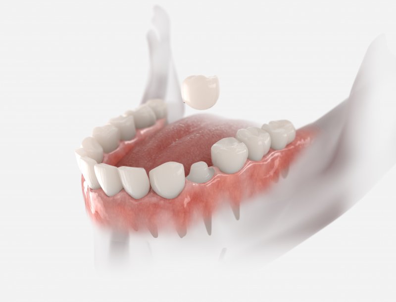 a 3D illustration of a tooth-colored dental crown